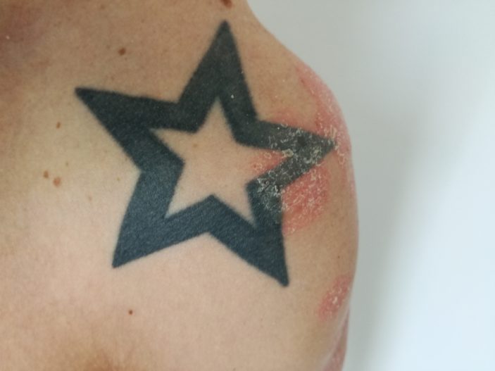 Ein Tattoo kann von Psoriasis überlagert werden