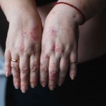 Palmoplantare Psoriasis: Schuppenflechte an Hand und Fuß