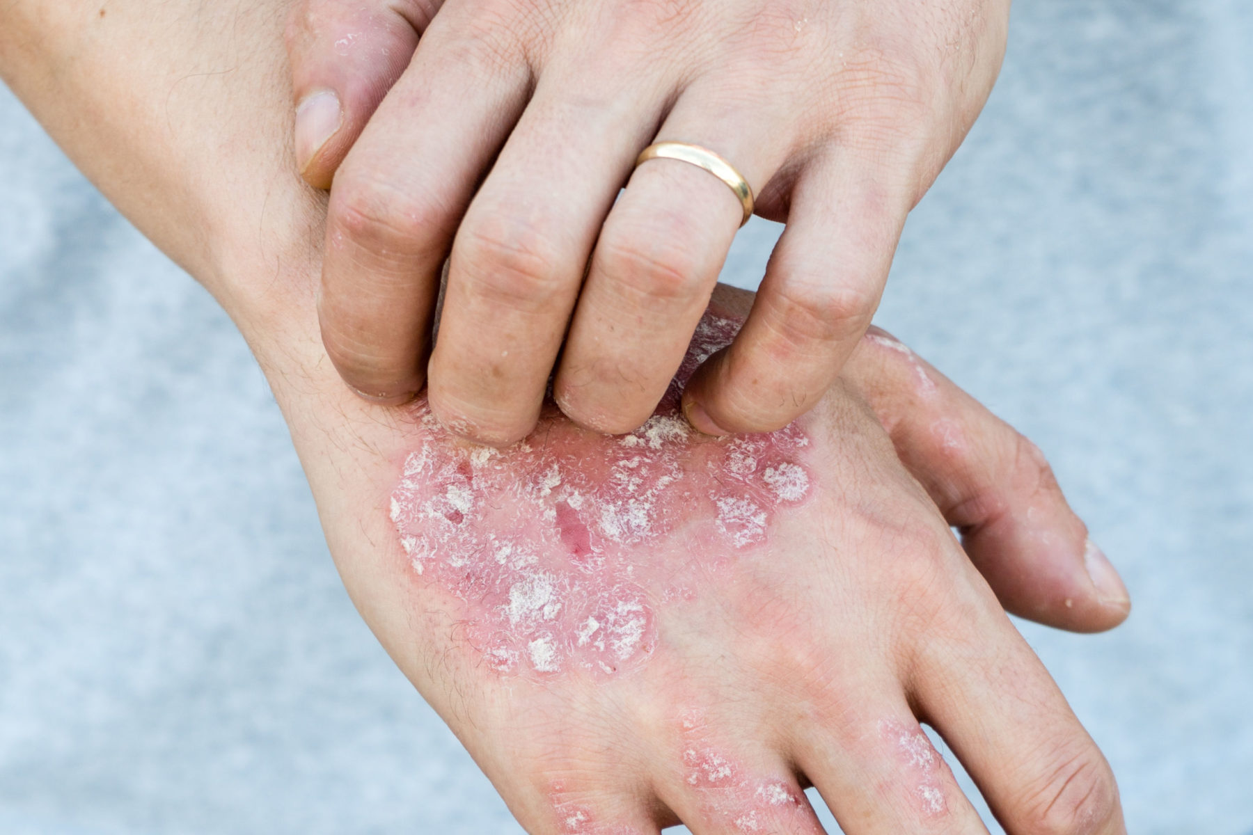 Plaque Hautver Nderungen Bei Psoriasis   Plaque 