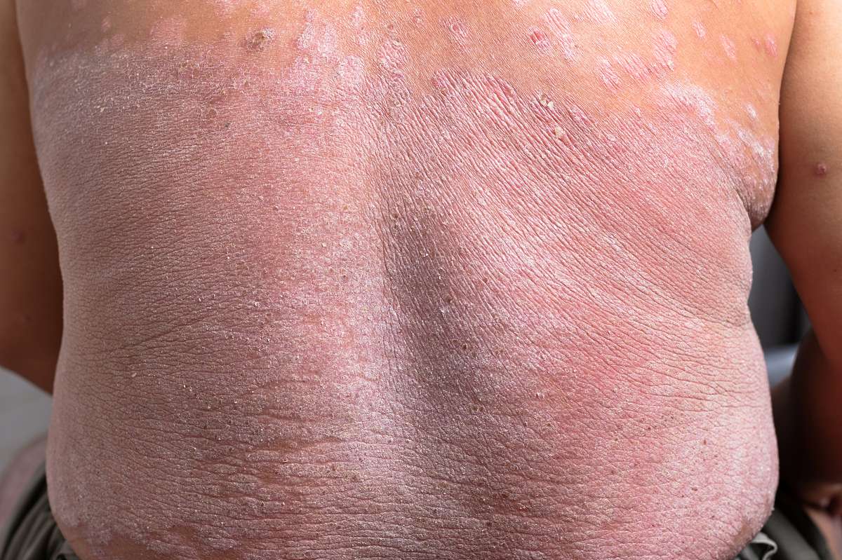 Schuppenflechte am Rücken Farbenhaut Alles über