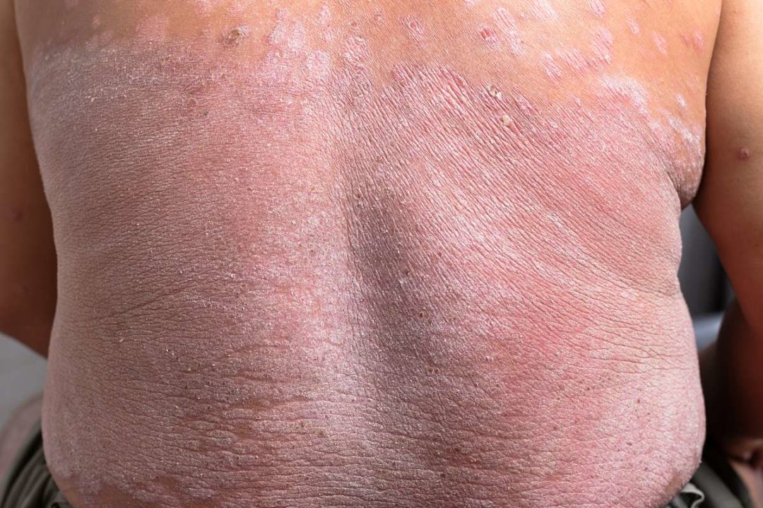 schuppenflechte hanf�l