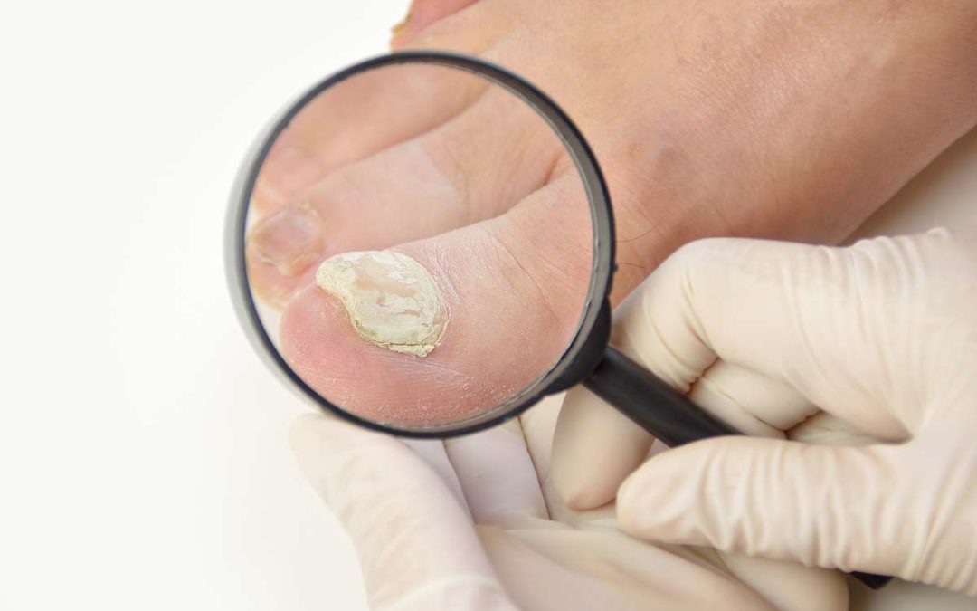 Krümelnägel und Tüpfelnägel – Symptome von Nagelpsoriasis