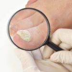 Krümelnägel und Tüpfelnägel – Symptome von Nagelpsoriasis