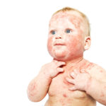 Baby mit Neurodermitis im Gesicht
