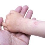 Neurodermitis Kleinkind: Ursachen, Behandlung, Verlauf und Tipps