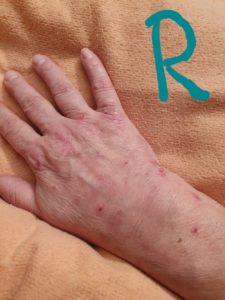 Bild zeigt Hand mit Psoriasis